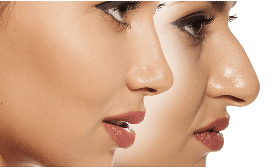 بوتاکس دیستون